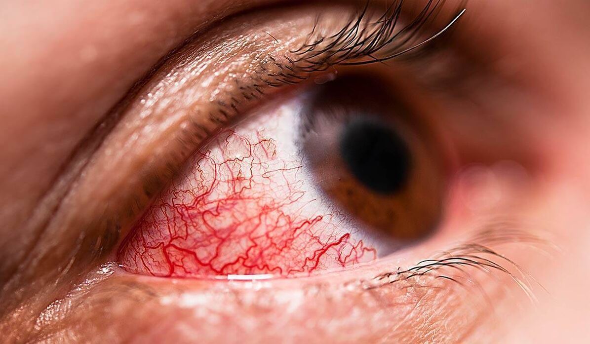 Retinopatia diabetică este una dintre complicațiile târzii ale diabetului